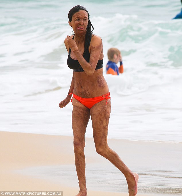 turia pitt 1