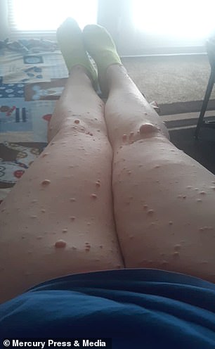 ashley pox feet 2