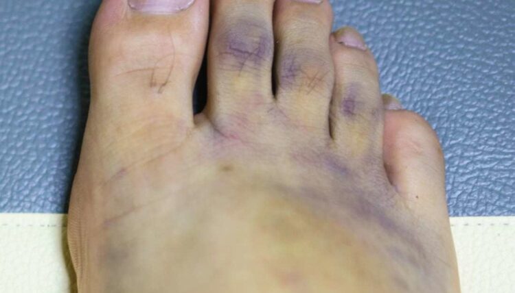 bruses feet 3