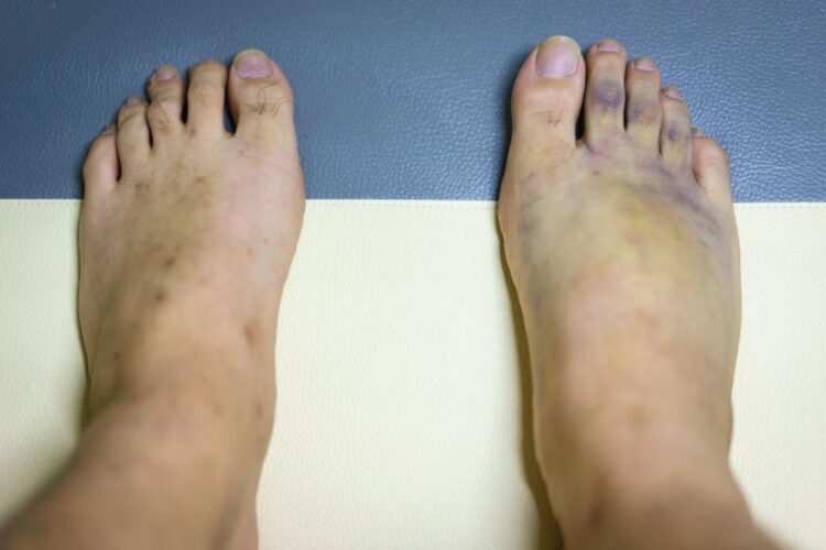 bruses feet
