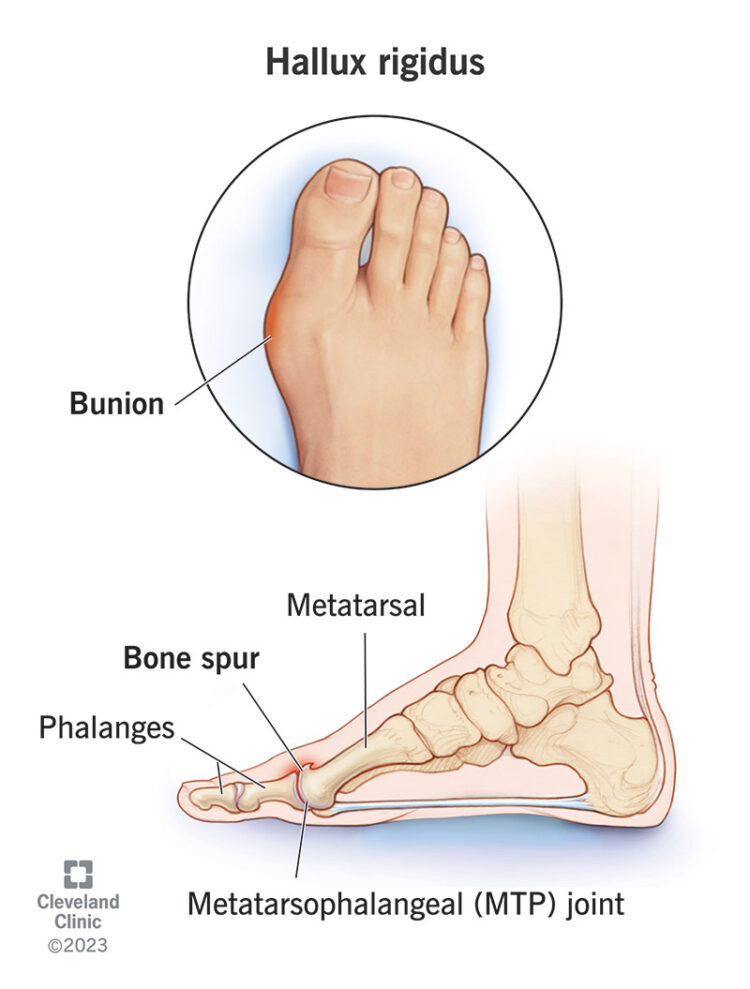 Completedisorder Feet