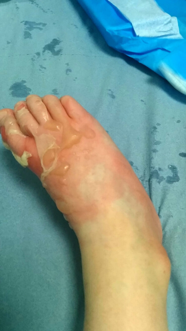 emma burns feet 3 scaled