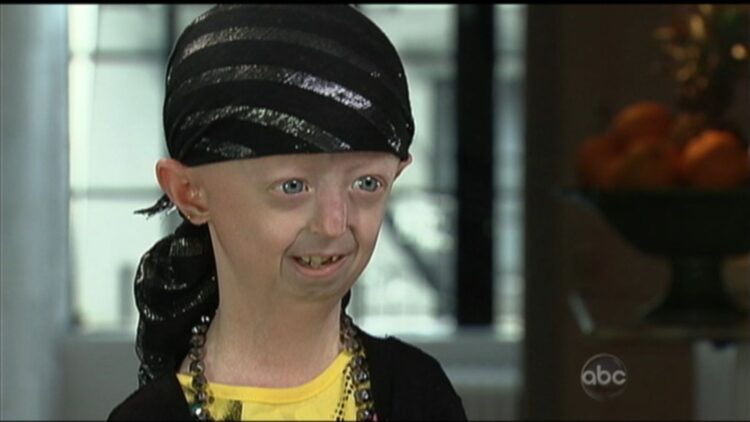 hayley okines feet 4