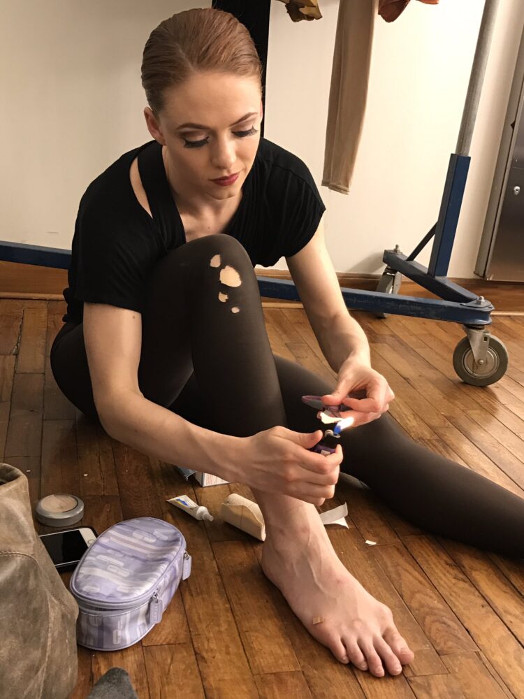 heather burns feet 1