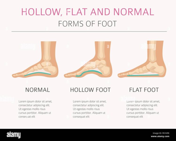 hollow feet 1