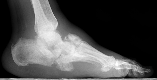 irm de bakker feet 1