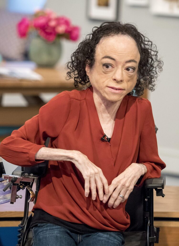 liz carr feet 3 scaled