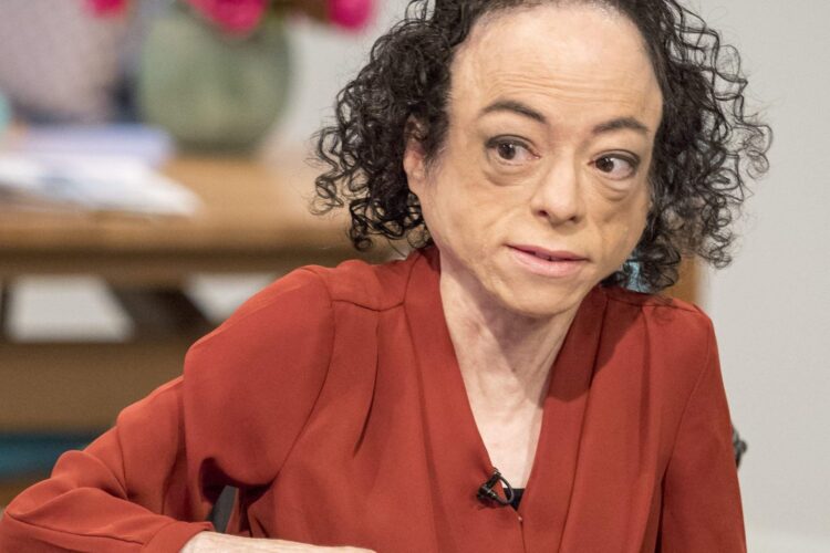 liz carr feet 5