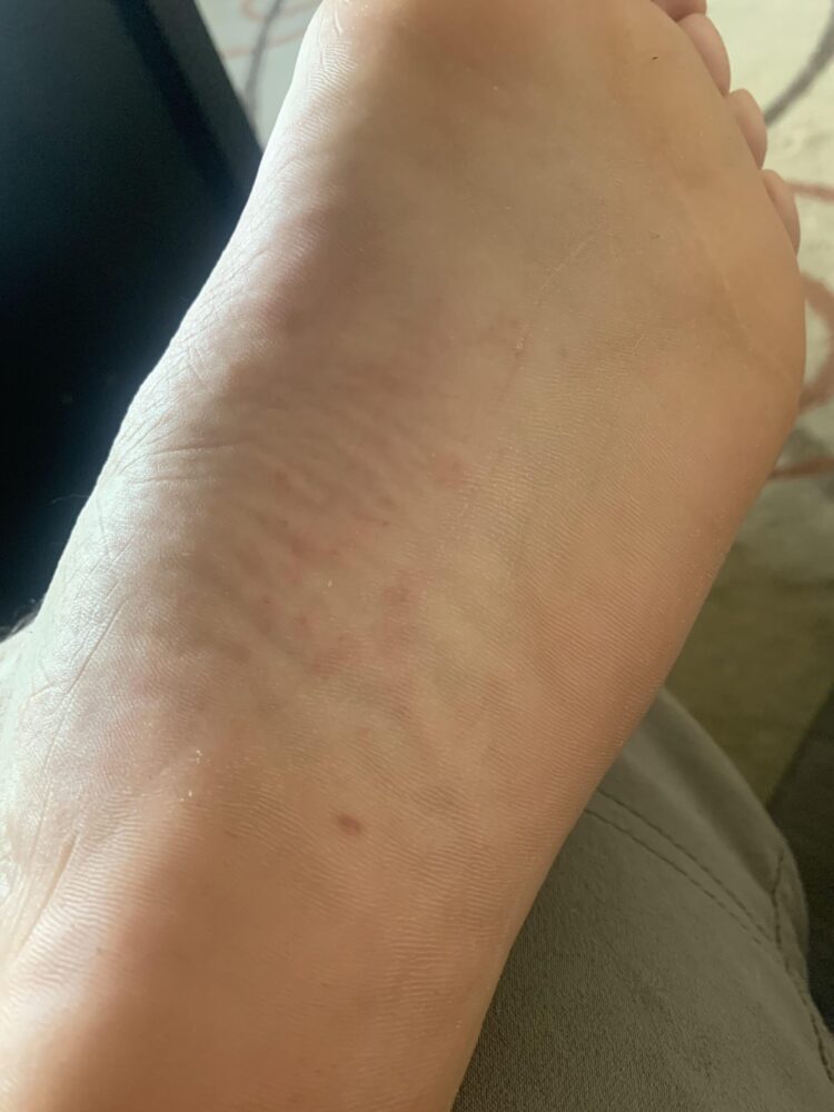 poison ivory feet 6 scaled