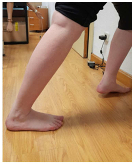 romeron demet feet 1