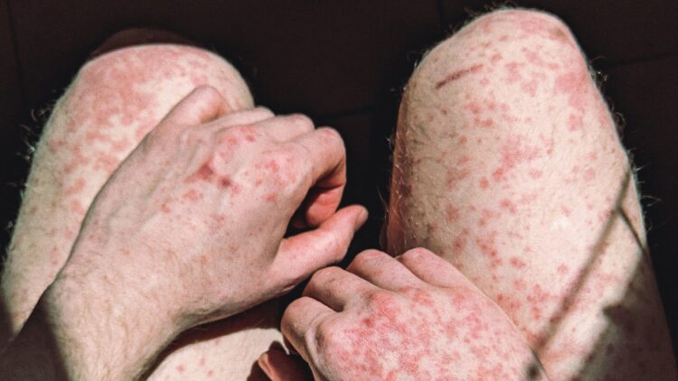 sarampiooon feet 3 scaled