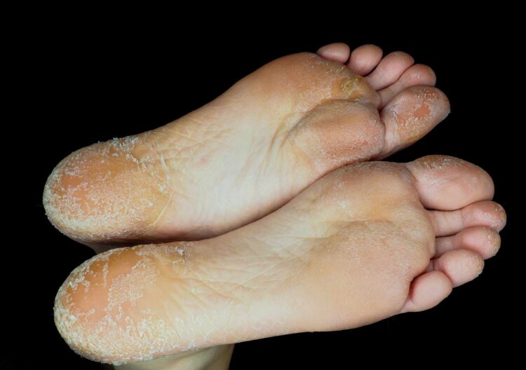 skin feet 6