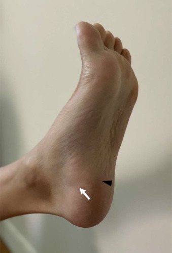 thay precerutti feet 3