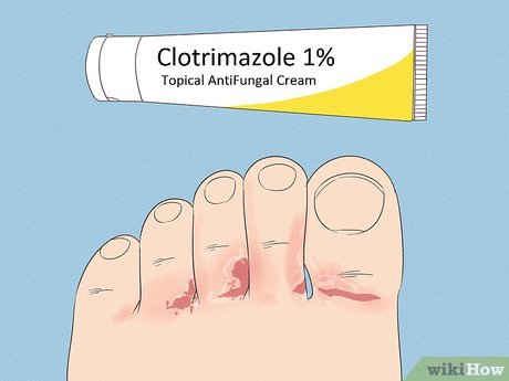 vanilla syndrome feet 3